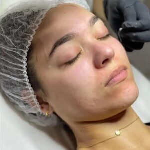 Blackheads on the face: professional extraction